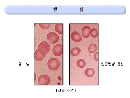 빈혈 (1).jpg